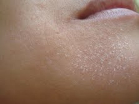 Trị da khô nứt nẻ mùa đông. Mùa đông lạnh giá thường làm cho làn da chúng ta trở nên khô ráp, nứt nẻ và thiếu sức sống. Có rất nhiều cách giúp bạn chăm sóc da vào mùa đông bằng các nguyên liệu có sẵn trong tự nhiên, trong đó có hoa cúc học mi. Hoa cúc họa mi chứa nhiều tinh dầu nên rất thích hợp với làn da khô thiếu dưỡng chất. Giã nát một lượng hoa cúc họa mi thích hợp sau đó trộn lẫn với lòng trắng trứng gà rồi thoa lên mặt trong vòng 10 phút thì rửa mặt lại với nước sạch.