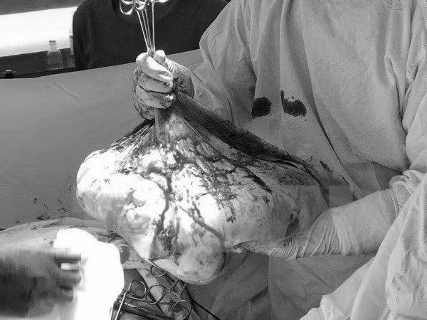 Nguoi phu nu bung to hon chua vi khoi u nang 35kg