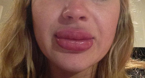 Có thể làm sưng môi, lưỡi, họng và gây khó thở do phù nề hầu họng hay đường hô hấp. Ảnh: Songkhoe.vn