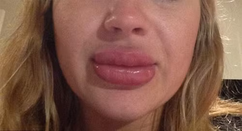 Có thể làm sưng môi, lưỡi, họng và gây khó thở do phù nề hầu họng hay đường hô hấp. Ảnh: Songkhoe.vn