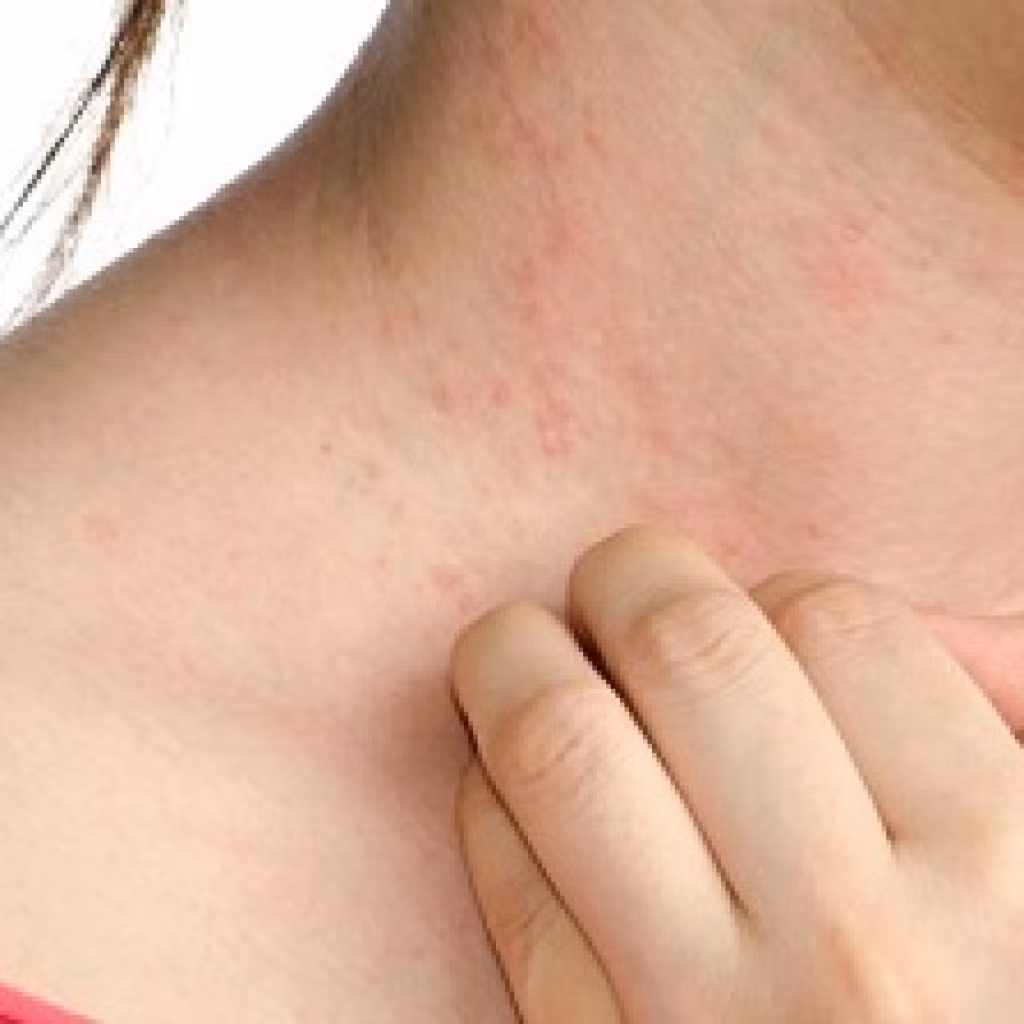 Ngứa là triệu chứng điển hình nhất: người bệnh có thể gặp phải tình trạng ngứa dữ dội, càng gãi càng ngứa, có người gãi đến chảy cả máu vẫn không đỡ ngứa. Ảnh: Vicare