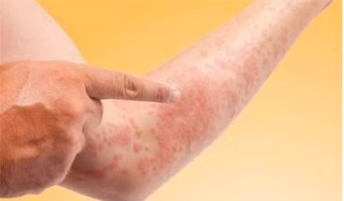 Triệu chứng của hiện tượng dị ứng thời tiết do lạnh bắt đầu ngay sau khi da tiếp xúc đột ngột với nhiệt độ hay không khí hoặc nước lạnh. Tình trạng này có thể mang đến những triệu chứng. Ảnh: Songkhoe.vn.