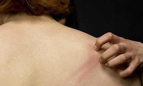 Tuyệt đối không gãi ngứa, tránh làm gia tăng những tổn thương cho da. Ảnh: Benhdalieu