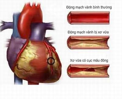Hệ tim mạch. Hút thuốc lá gây tổn thương tới toàn bộ hệ tim mạch. Khi nicotin được hít vào cơ thể, nó khiến cho mạch máu bị co lại, cản trở lưu thông máu. Hút thuốc làm giảm hàm lượng cholesterol tốt và tăng huyết áp, có thể dẫn tới giãn động mạch và tích tụ cholesterol xấu. Hút thuốc cũng làm tăng nguy cơ hình thành cục máu đông từ đó tăng nguy cơ bệnh tim và đột quỵ. Về lâu dài, những người hút thuốc có nguy cơ cao hơn bị ung thư máu. Ảnh: http://huyetap.net/
