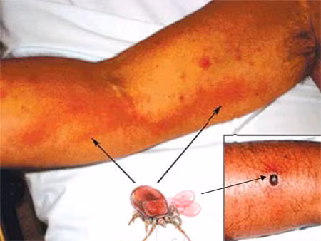 Bệnh sốt mò dễ nhầm lẫn với các bệnh khác. Ảnh: Khoeplus.vn