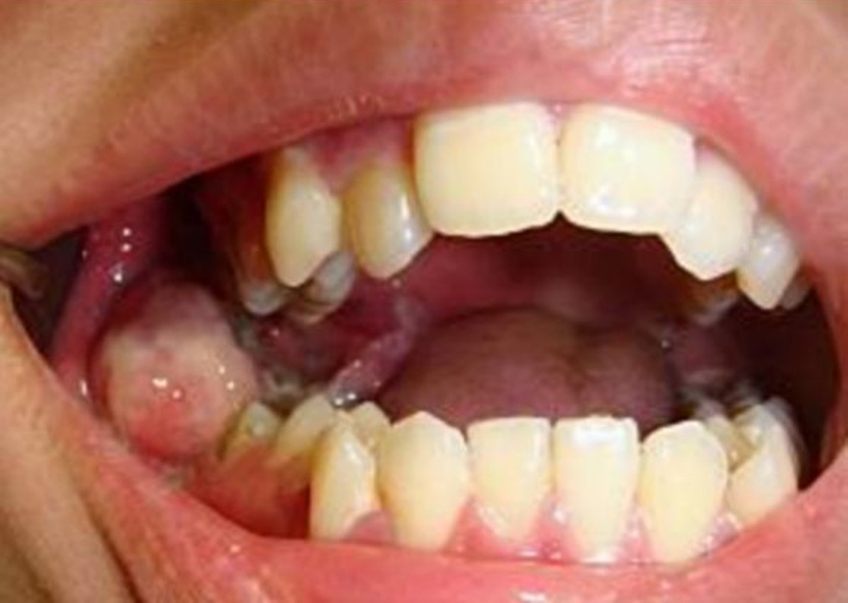 Sau nho rang khon, thanh nien 18 tuoi ung thu day mom gay soc