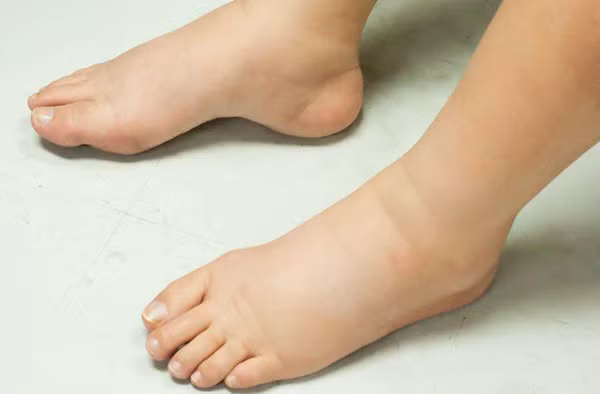 Phù. Thận có chức năng chuyển hóa nước. Khi bị suy thận, cơ thể sẽ có hiện tượng giữ nước gây phù. Đầu tiên, bệnh nhân sẽ thấy phù mặt rồi dần xuất hiện các triệu chứng như phù mắt cá chân, phù toàn thân.