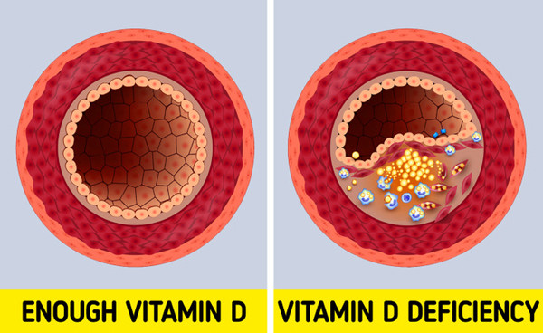 Dễ bị ốm. Vitamin D giúp cơ thể tăng cường sản xuất các kháng thể, nhờ vậy củng cố hệ miễn dịch. Thiếu vitamin D khiến hệ miễn dịch suy yếu, cơ thể dễ nhiễm khuẩn, mắc các bệnh như cảm lạnh, viêm phế quản và viêm phổi.