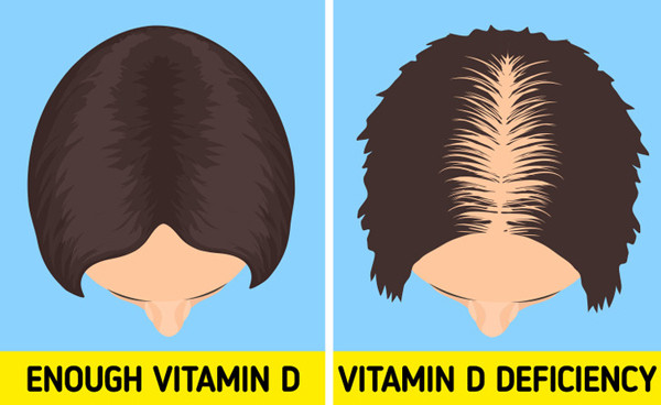 Rụng tóc, tóc mỏng. Vitamin D cần thiết để tế bào da xử lý keratin - một loại protein cần thiết cho sự phát triển của tóc và móng tay. Thiếu hụt vitamin D khiến lượng keratin sản xuất ra không đủ, ảnh hưởng đến tình trạng tóc, gây nên hiện tượng rụng tóc, mỏng tóc.