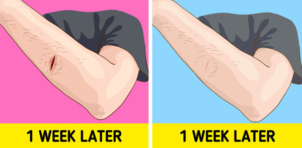 Vết thương khó lành. Ngoài mắc bệnh tiểu đường, thiếu vitamin D cũng là nguyên nhân khiến vết thương lâu lành. Kết quả nghiên cứu chỉ ra, vitamin D tham gia điều chỉnh các yếu tố phát triển của mô mới. Thiếu hụt nó khiến việc tái tạo mô mới diễn ra chậm hơn.