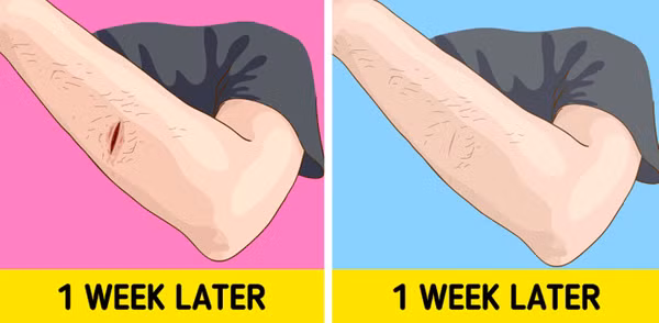 Vết thương khó lành. Ngoài mắc bệnh tiểu đường, thiếu vitamin D cũng là nguyên nhân khiến vết thương lâu lành. Kết quả nghiên cứu chỉ ra, vitamin D tham gia điều chỉnh các yếu tố phát triển của mô mới. Thiếu hụt nó khiến việc tái tạo mô mới diễn ra chậm hơn.