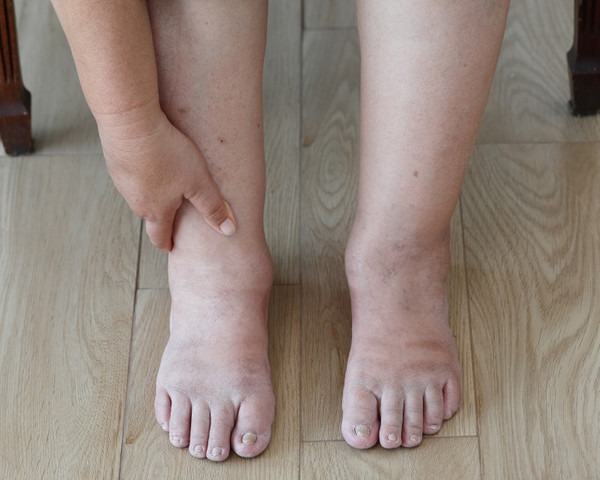 Mắt cá chân sưng. Mắt cá chân sưng là hiện tượng phổ biến khi phụ nữ mang thai. Trong khi đó, nếu bạn không có bầu, tình trạng mắt cá chân sưng có thể do máu lưu thông kém, các vấn đề về tim hoặc tuyến giáp. Ngoài ra, ăn mặn dẫn đến giữ nước cũng có thể khiến phần mắt cá chân sưng.