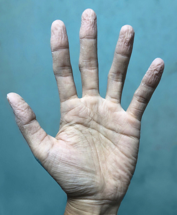 Da bàn tay, ngón tay nhăn nheo. Da bàn tay, ngón tay nhăn nheo chủ yếu do quá trình lão hóa hoặc ngâm tay dưới nước thời gian dài. Đây là hiện tượng bình thường, không cần bận tâm nhiều. Vậy nhưng, nếu da tay đột ngột hình thành nếp nhăn, mất độ đàn hồi nhanh hơn các bộ phận khác thì đây có thể là dấu hiệu cơ thể có bệnh, cần hết sức chú ý. Theo chuyên gia, tình trạng có thể do lưu thông máu kém hoặc các vấn đề về tuyến giáp.