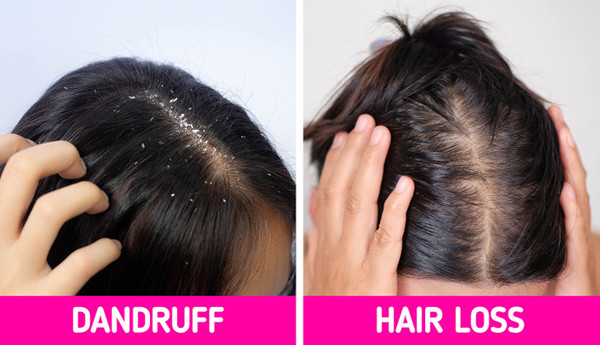 Gàu, rụng tóc. Da đầu xuất hiện nhiều gàu không đơn thuần do tóc bẩn. Đầu có gàu, rụng tóc nhiều có thể là dấu hiệu của tình trạng thiếu hụt vitamin và dưỡng chất quan trọng. Thông thường, tình trạng bắt nguồn do thiếu kẽm, vitamin B2, B3, B6, B7 và sắt. (Ảnh: BS, minh họa)