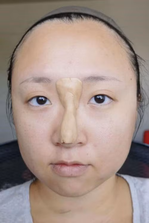 Hỗn hợp này sau đó sẽ được đắp lên sống mũi một cách khéo léo...