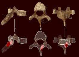 Ngoài ra, một khối u lành tính còn cổ xưa hơn đã được tìm thấy ở loài Australopithecus sediba, sống cách đây 1,9 triệu năm.