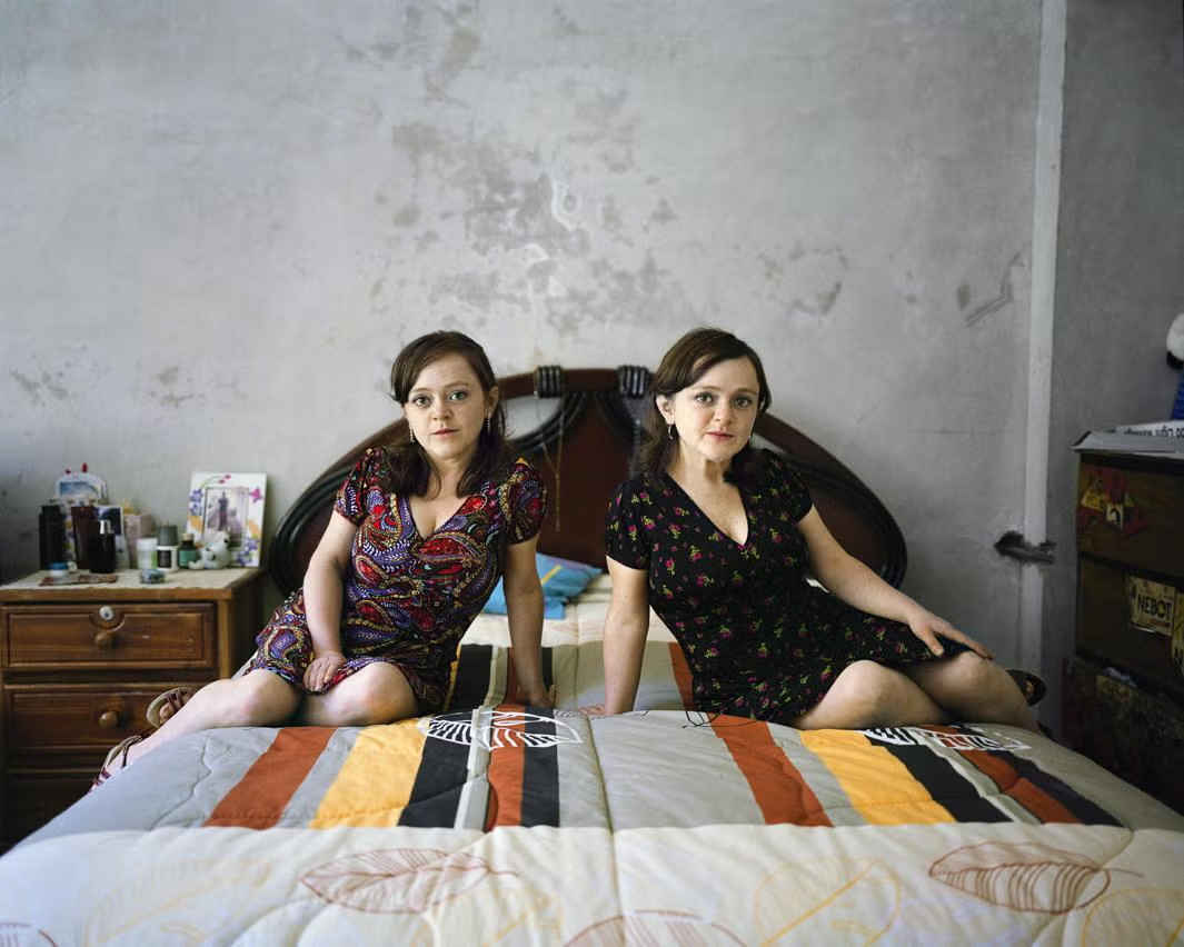 2. Người bản địa ở Ecuador: Khoảng 100 người trong một bộ lạc ở Ecuador mắc Hội chứng Laron (LS), một đột biến gen gây ra tình trạng lùn. Hội chứng này bảo vệ họ khỏi ung thư, tiểu đường, bệnh tim mạch và Alzheimer.