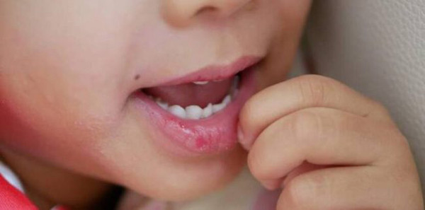 Nếu da môi bong tróc, trẻ sẽ rất khó chịu và tìm cách để bóc ra. Trường hợp này, bạn nên rửa tay sạch rồi dùng kéo đã được tiệt trùng để cắt bỏ. Bố mẹ cần bảo đảm vệ sinh dụng cụ, tay sạch sẽ tránh trẻ bị viêm nhiễm.