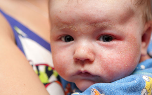 Trong khi đó, tuyến bã nhờn ở trẻ phát triển chưa hoàn thiện nên tình trạng khô, nứt nẻ diễn ra càng mạnh. Nếu dùng đèn sưởi hoặc đốt lửa sưởi ấm, nhiệt độ môi trường tăng càng đẩy nhanh quá trình mất nước trong cơ thể.