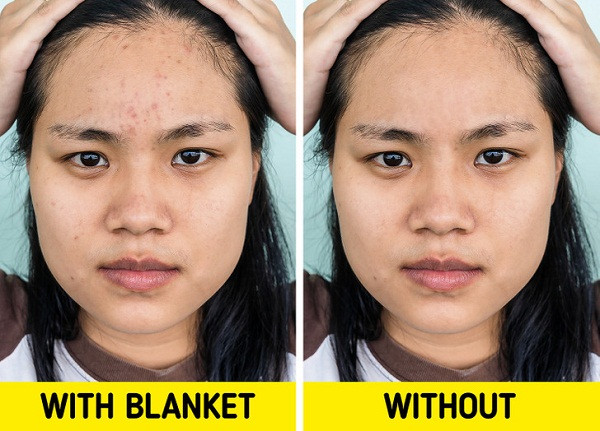 Tốt cho da: Đắp những chiếc chăn dày, bạn có thể mọc nhiều mụn hơn. Nguyên nhân bởi những chiếc chăn dày được làm từ vải tổng hợp dễ tích tụ chất bẩn. Điều này rất bất lợi khi bề mặt chăn tiếp xúc với da.