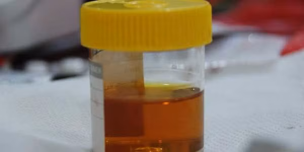 Nước tiểu vàng đặc: Buổi sáng mới thức dậy, nếu nước tiểu trong hoặc vàng sáng thì là tín hiệu sức khỏe tốt. Ngược lại, nếu chức năng gan suy giảm, rối loạn phân hủy và chuyển đổi bilirubin, màu sắc nước tiểu sẽ thay đổi.