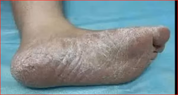 Quan sát mức độ nứt nẻ của hai bên chân. Nếu hai bên nặng nhẹ không tương đồng, một bên có triệu chứng nhẹ, một bên có triệu chứng nặng hơn hoặc chỉ một bàn chân nứt nẻ thì có khả năng bạn đã nhiễm nấm.