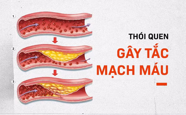 Để làm “mềm” mạch máu, bạn nên hạn chế đồ chiên nướng, ăn nhiều rau củ. Những thực phẩm như hành tây, súp lơ, củ cải, bầu sáp, nấm, cà chua, đậu nành... chứa nhiều axit béo không no, có khả năng giúp mạch máu tăng tính đàn hồi rất được khuyến khích trong thực đơn hàng ngày, giúp cơ thể tráng kiện, sống lâu.