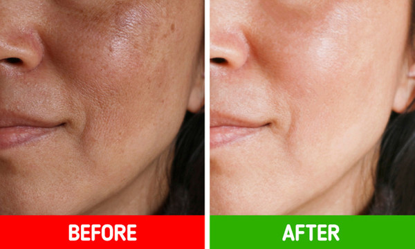 Nước ép khoai tây loại bỏ vết thâm. Làm đẹp ngày Tết, chị em không nên bỏ qua nước ép khoai tây. Thực tế, khoai tây có chứa chất tẩy trắng tự nhiên, góp phần điều trị mụn, vết cháy nắng, vết thâm trên da cực tốt.