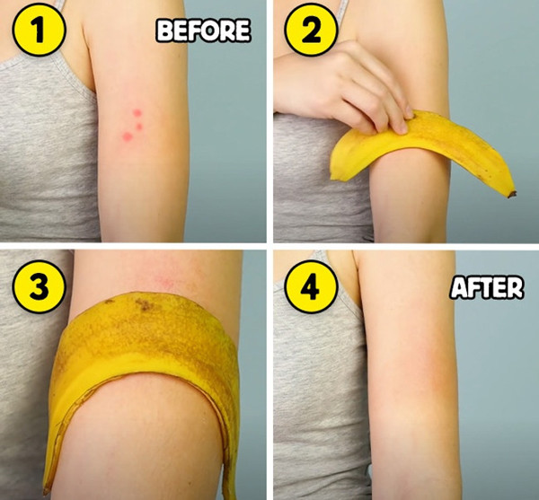 Làm mờ sẹo bằng vỏ chuối. Vỏ chuối chứa vitamin C và vitamin E, cùng kali, kẽm, sắt... có tác dụng làm dịu da bị viêm, giảm sự bùng phát mụn trứng cá. Hơn nữa, vỏ chuối có chứa lutein và carotenoids - những hợp chất hòa tan trong chất béo giúp chống viêm và mụn trứng cá. Khi thực hiện, bạn chà vỏ chuối lên da hai lần mỗi ngày và để trong 5-10 phút trước khi rửa sạch.