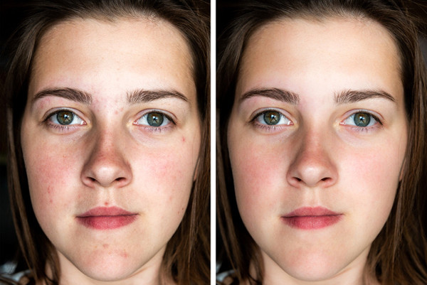 Làm dịu cơ da bằng trà hoa cúc. Nhiều người chuộng uống trà hoa cúc trước khi ngủ để làm dịu cơ thể và thần kinh. Đáng lưu ý, đây cũng là nguyên liệu tuyệt vời để làm giảm mẩn đỏ, trị viêm da. Rửa mặt hàng ngày với trà hoa cúc sẽ giúp bạn tận dụng các chất chống viêm, dưỡng ẩm trong chúng.