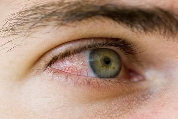 Triệu chứng hiếm gặp của COVID-19 xuất hiện ở mắt Trieu chung hiem gap cua COVID-19 xuat hien o mat