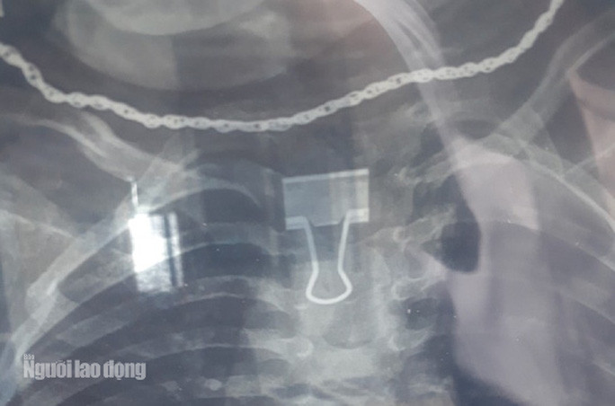 Ta hoa phat hien kep giay mac trong co be 2 tuoi