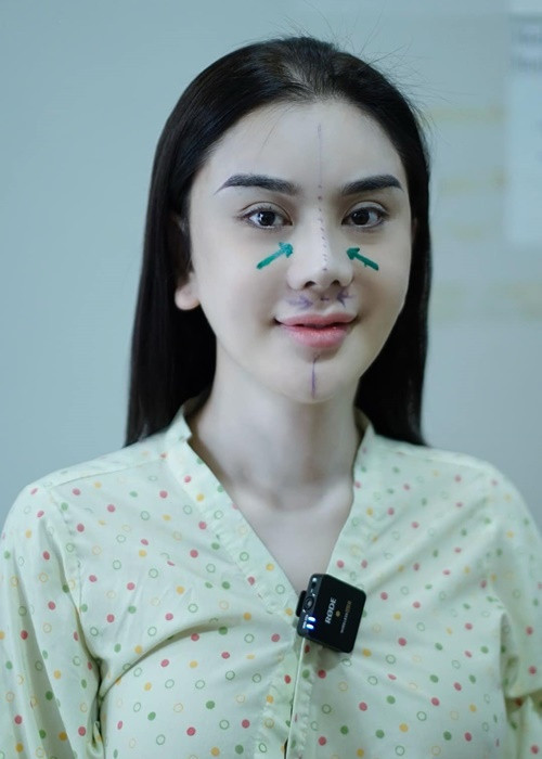 Nữ ca sĩ chuyển giới chia sẻ hình ảnh dao kéo mũi. Ảnh: FBNV.