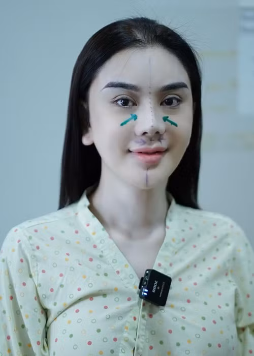 Nữ ca sĩ chuyển giới chia sẻ hình ảnh dao kéo mũi. Ảnh: FBNV.