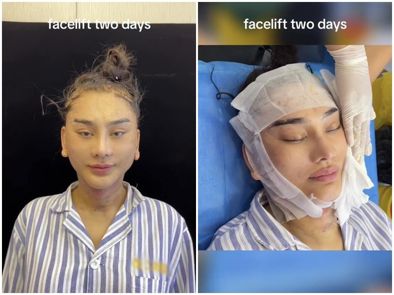 Quá trình phẫu thuật thẩm mỹ của Lâm Khánh Chi kéo dài 7 tiếng. Trong ảnh là nữ ca sĩ sau 2 ngày chỉnh sửa gương mặt. Ảnh: Người Đưa Tin.
