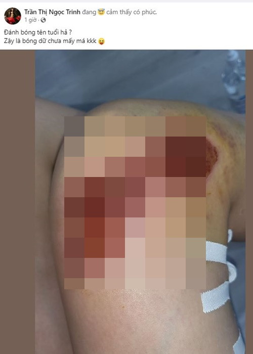 Việc Ngọc Trinh lái mô tô, tạo dáng nguy hiểm khiến nhiều người đặt nghi vấn người đẹp mượn ồn ào để PR. Đối mặt với nghi vấn này, Ngọc Trinh phủ nhận. Cô đăng tải hình ảnh chân bị thương và viết: “Đánh bóng tên tuổi hả? Vậy là bóng dữ chưa?”. Ảnh chụp màn hình.