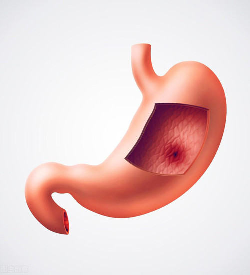 Bệnh dạ dày. Nhiễm khuẩn Helicobacter pylori (HP) là một trong những nguyên nhân phổ biến nhất khiến hơi thở có mùi. Đây cũng là yếu tố gây nên bệnh viêm loét dạ dày. Theo chuyên gia, nếu thường xuyên bị trào ngược axit, ợ hơi, bạn nên đi viện khám để kiểm tra có nhiễm HP không.