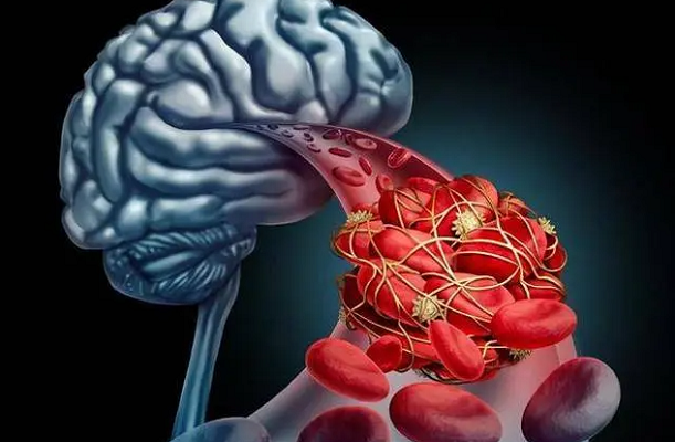 Lưu ý, khi phát hiện những dấu hiệu xuất huyết não, người bệnh cần giữ bình tĩnh, không tự ý đi lại, không tự ý uống thuốc. Mọi bất cẩn thời điểm này đều có thể khiến các triệu chứng nặng hơn, gây xuất huyết cấp tính, đe dọa trực tiếp tính mạng người bệnh.