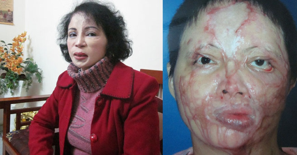 Chị Nguyễn Thị Kim Loan (SN 1965) được bổ nhiệm thành thẩm phán năm 1999. Năm 2005, một đối tượng đã tạt axit chị Loan do nữ thẩm phán không nhận tiền hối lộ trong một vụ án tranh chấp đất đai. Năm 2014, chị trở lại công tác tại TAND tối cao.