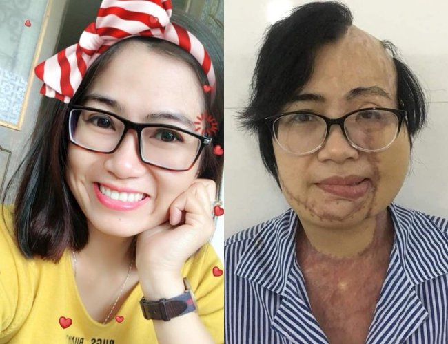 Cuối tháng 3/2018, chị Đặng Thị Huyền (SN 1985, trú tại thị trấn Yên Viên, huyện Gia Lâm, Hà Nội) - giáo viên dạy tiếng Anh bị chồng cũ là Phạm Văn Thông (SN 1983, quê Thái Bình) dùng axit tạt lên người trước mặt con gái. 