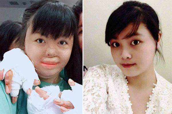 Chị Nguyễn Thùy Dung (SN 1994, xã Chàng Sơn, huyện Thạch Thất, Hà Nội) phải sống trong hình hài bị biến dạng khuôn mặt cùng một số bộ phận trên cơ thể. Dung chủ động viết đơn ly dị chồng là Nguyễn Văn Thành (SN 1991, xã Hòa Thạch, huyện Quốc Oai) do đối tượng này nghiệp ngập, cờ bạc. Níu kéo không được, Thành đã dùng xăng thiêu vợ. 