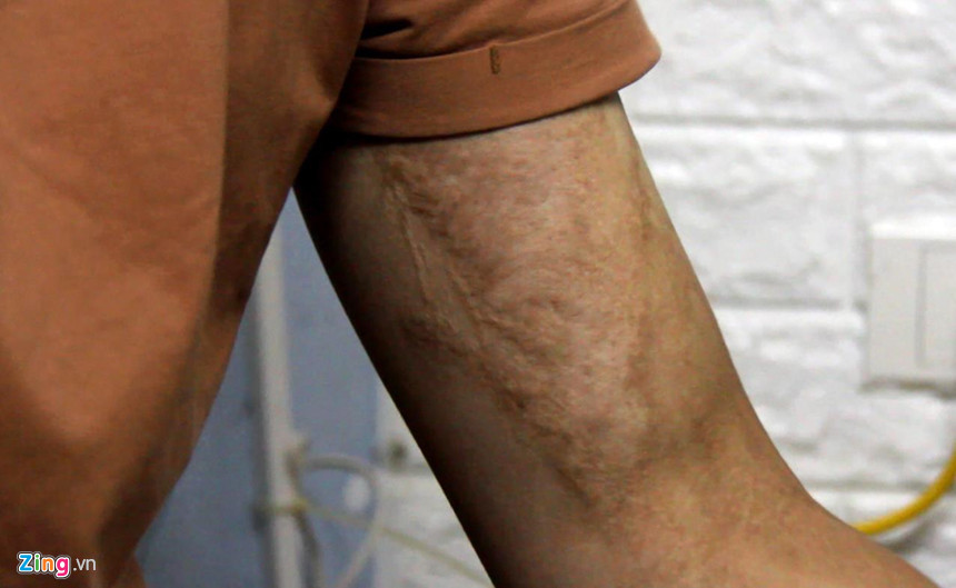 Nam sinh truong dien anh dep trai ke lai phut kinh hoang bi danh ghen bang axit-Hinh-2