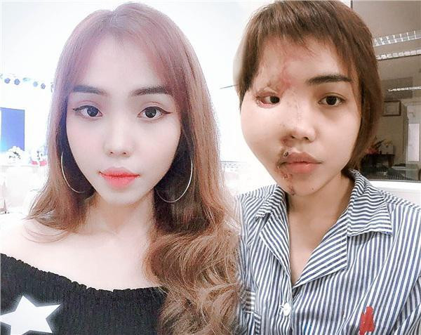 Thieu uy cong an tat axit vo sap cuoi: Vi sao co hai ket qua giam dinh?