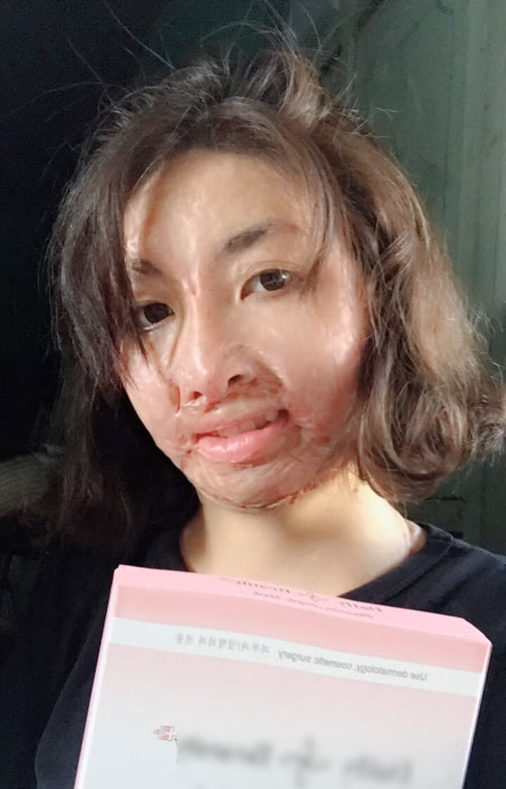 Co gai Yen Bai bi chong MC tam xang dot: No luc tim lai hinh hai-Hinh-3