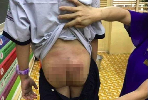 Be 10 tuoi bi bo, me ke bao hanh: Me duoc quyen nuoi, sao “un” cho bo?