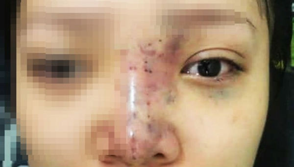 Nu sinh mu mat khi tiem filler: Tiet lo tu bac si-Hinh-2