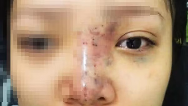 Nu sinh mu mat khi tiem filler: Tiet lo tu bac si-Hinh-2