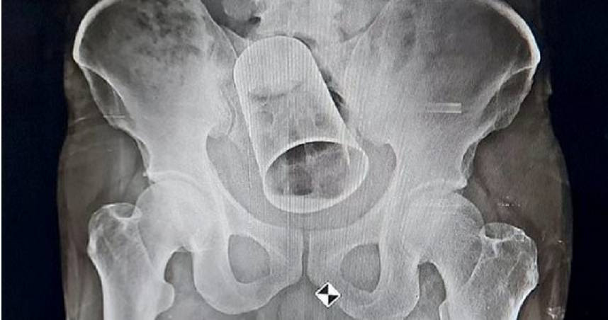 Say ruou, nguoi dan ong bi ban choi kham suyt hong hau mon