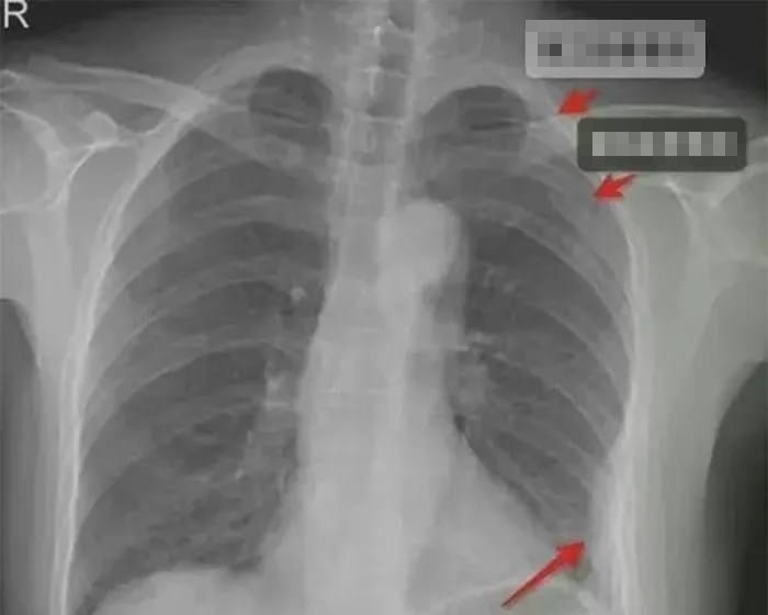 Bi nam dong nghiep om qua manh, co gai gay 3 xuong suon