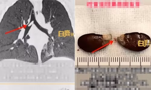 Vua an vua cuoi, be trai gap tai nan nguy hiem: Bac si canh bao